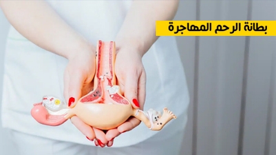 بطانة الرحم المهاجرة