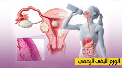 الورم الليفي الرحمي