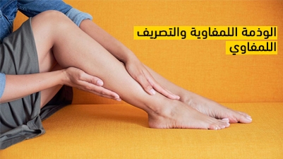 الوذمة اللمفاوية والتصريف اللمفوي