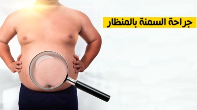جراحة السمنة بالمنظار