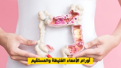 أورام الأمعاء الغليظة والمستقيم