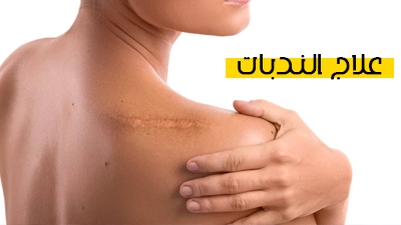علاج الندبات