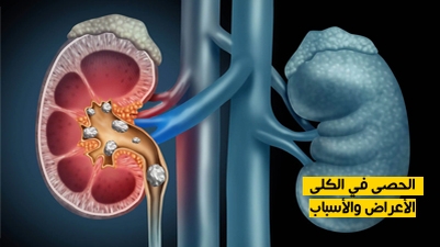 الحصى في الكلى : الأعراض والأسباب