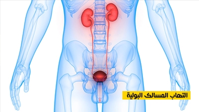 التهاب المسالك البولية