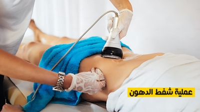 عملية شفط الدهون