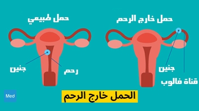 الحمل خارج الرحم
