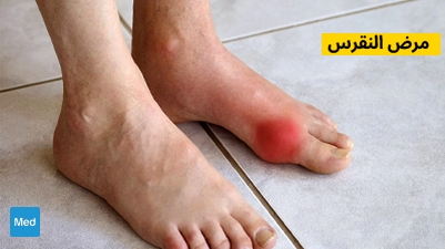 مرض النقرس - التشخيص والأسباب والعلاج