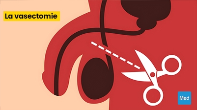 Comprendre la Vasectomie