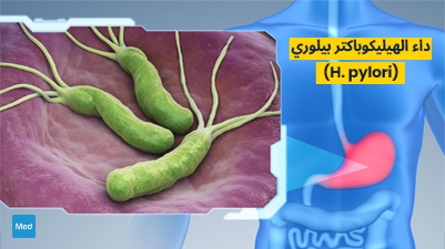 داء الهيليكوباكتر بيلوري (H. pylori)
