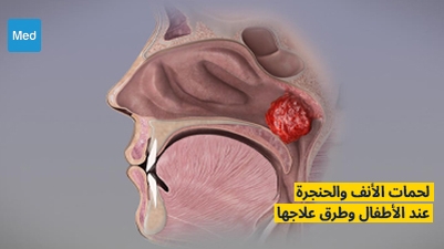 لحمات الأنف والحنجرة وطرق علاجها