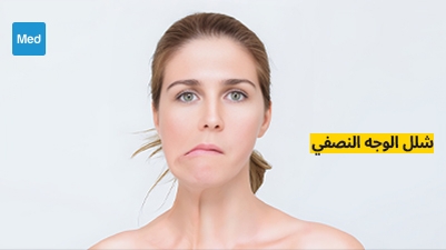 شلل الوجه النصفي