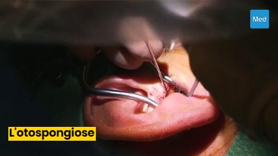 Otospongiose : tout ce que vous devez savoir