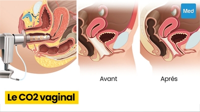 CO2 vaginal : une solution efficace pour les problèmes vulvo-vaginaux