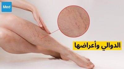 الدوالي وأعراضها