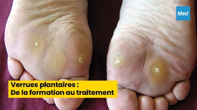 Verrues plantaires : De la formation au traitement
