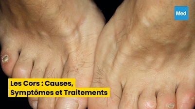 Les Cors : Causes, Symptômes et Traitements