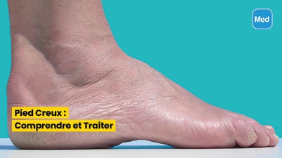 Pied Creux : Comprendre et Traiter