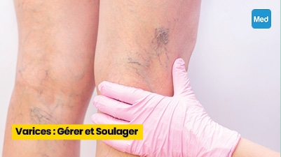 Varices : Gérer et Soulager