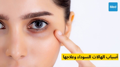 أسباب الهالات السوداء وعلاجها