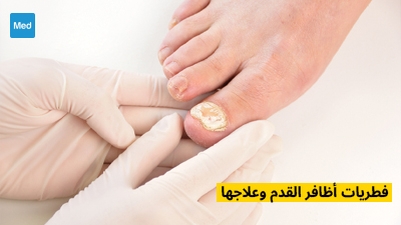 فطريات أظافر القدم وعلاجها