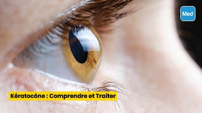 Kératocône : Comprendre et Traiter