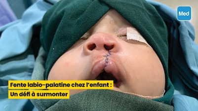 Fente labio-palatine chez l