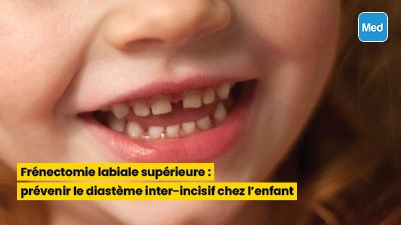 Frénectomie labiale supérieure  prévenir le diastème chez l