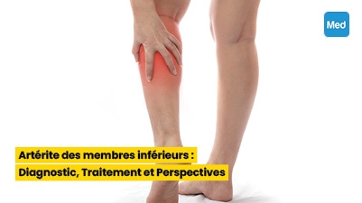 Artérite des membres inférieurs : Diagnostic, Traitement et Perspectives