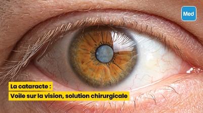 La cataracte : Voile sur la vision, solution chirurgicale
