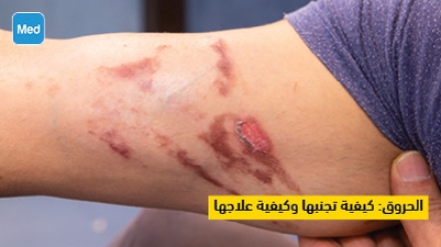 الحروق : كيفية تجنبها وكيفية علاجها 