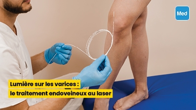 Lumière sur les varices : le traitement endoveineux au laser