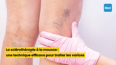 La sclérothérapie à la mousse : une technique efficace pour traiter les varices