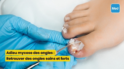 Adieu mycose des ongles : Retrouver des ongles sains et forts