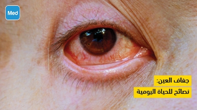 جفاف العين: نصائح للحياة اليومية