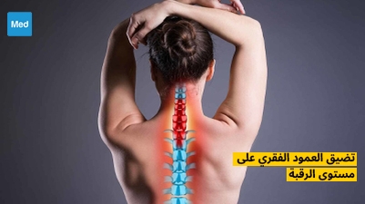 تضيق العمود الفقري على مستوى الرقبة