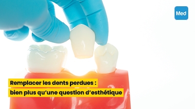 Remplacer les dents perdues : bien plus qu