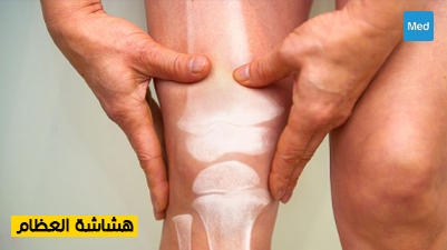 هشاشة العظام