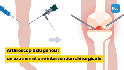 Arthroscopie du genou : un examen et une intervention chirurgicale