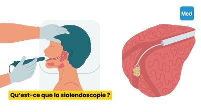 Qu’est-ce que la sialendoscopie ?