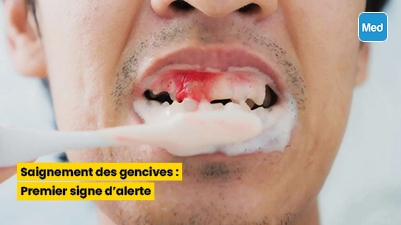 Saignement des gencives : Premier signe d
