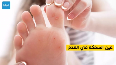 عين السمكة في القدم