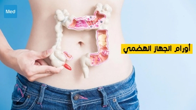 أورام الجهاز الهضمي 