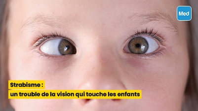 Strabisme : un trouble de la vision qui touche les enfants