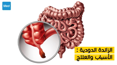 الزائدة الدودية : الأسباب والعلاج