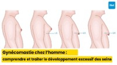 Gynécomastie chez l’homme : comprendre et traiter le développement excessif des seins