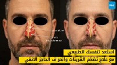 استعد تنفسك الطبيعي مع علاج تضخم القرينات وانحراف الحاجز الأنفي