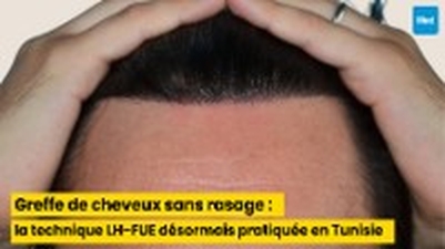Greffe de cheveux sans rasage : la technique LH-FUE désormais pratiquée en Tunisie
