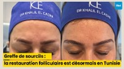 Greffe de sourcils : une microchirurgie de restauration folliculaire, désormais pratiquée en Tunisie
