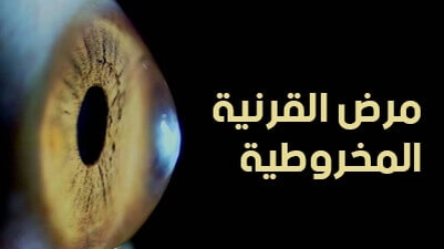 مرض القرنية المخروطية