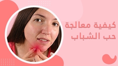 كيفية معالجة حب الشباب